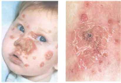 Impetigo - cauze si simptome Impetigo