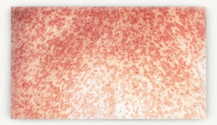 De unde știi că aveți varicela