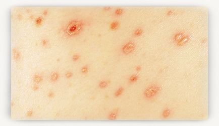 De unde știi că aveți varicela