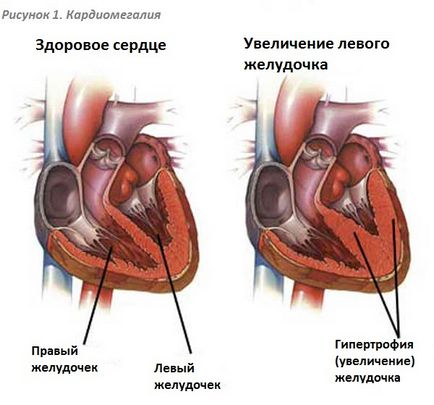 cardiomegaliei-l