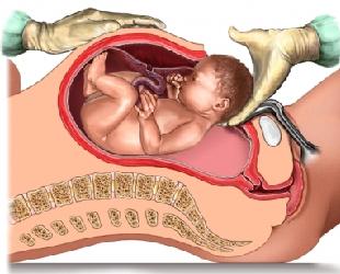 Argumente pro și contra cesarean secțiune, avantajele și dezavantajele cezariana și cezariana nastere naturala