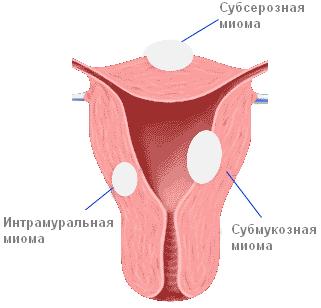 Ce se va întâmpla dacă există fibroame