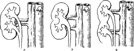 Care este dublarea parțială a rinichilor