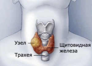 Ansamblu de eliminare tiroidă