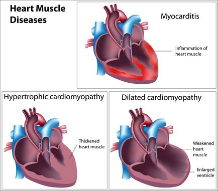 cardiomegaliei-l