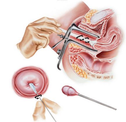 Însămânțarea canalului cervical care este