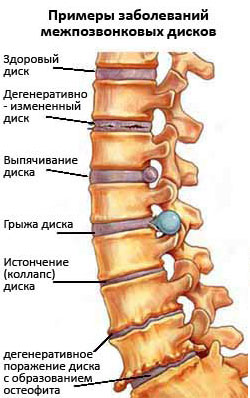 Ce este osteocondrozei comun