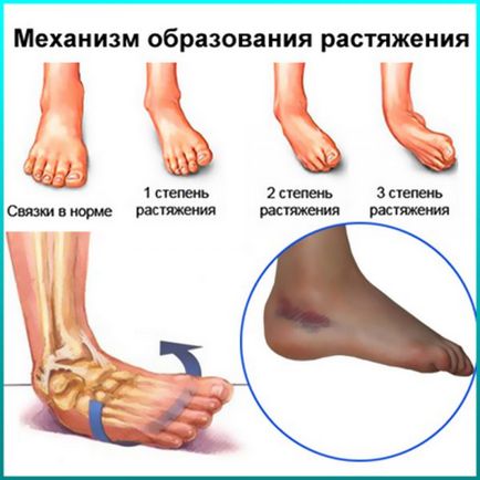 Pentru tratamentul rupturile de ligament