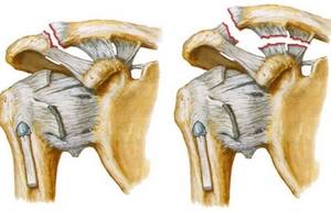 Pentru tratamentul rupturile de ligament