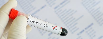 Diagnosticul de sifilis