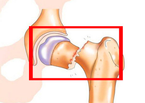 Ce este o fractura de clavicula