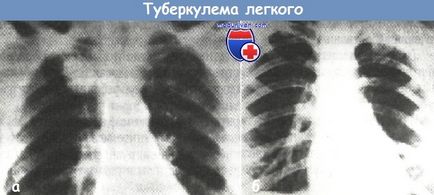 Ce este tuberculoma pulmonar