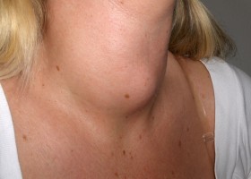 Ansamblu de eliminare tiroidă