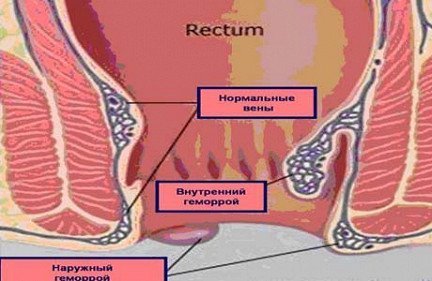 Cum de a trata hemoroizi la barbati
