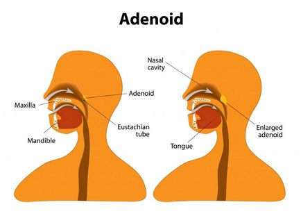 Vegetații adenoide în nas - Tratamentul