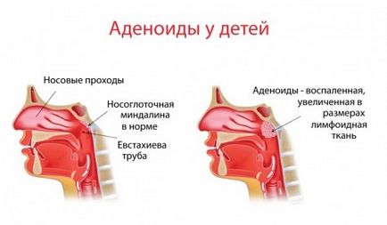 Vegetații adenoide în nas la copii - simptome și tratament, fotografii