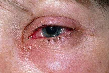 Alergia la simptome produse chimice de uz casnic și boli raznovodnosti