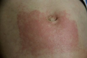 Alergic la transpirație - simptome, cauze si tratament