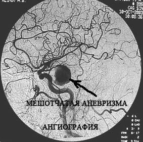 Anevrism cerebral - cauze, simptome si tratament