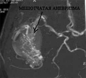 Anevrism cerebral - cauze, simptome si tratament