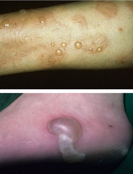 Buloase dermatita de patologie clasificare, cauze și simptome, principii de tratament, fotografii