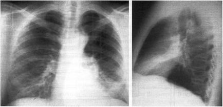 Diagnostic, diagnostic diferențial și tratamentul sindromului de compresie parenchimului pulmonar
