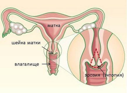 Eroziune cervicală - Simptome, cauze de, tratament