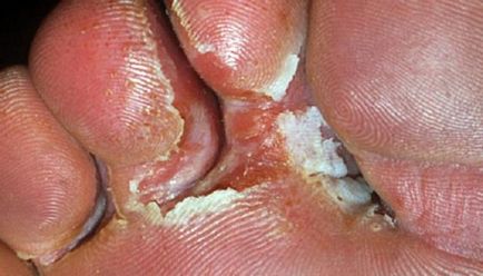 Mucegaiuri pe fotografii picioare, simptome și tratament