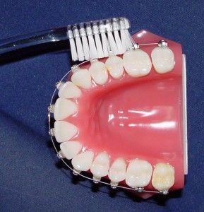 Cum să se spele pe dinti cu aparat dentar corect