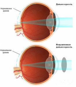 Cum de a trata hipermetropie sau ce să facă în cazul în care cu deficiențe de vedere