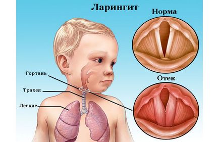 Cum de a trata laringite la copii - cel mai bun mod de a vindeca rapid copilul
