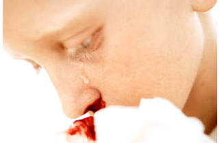 Cum de a opri sângerarea din nas a copilului în gazdă (primul ajutor)
