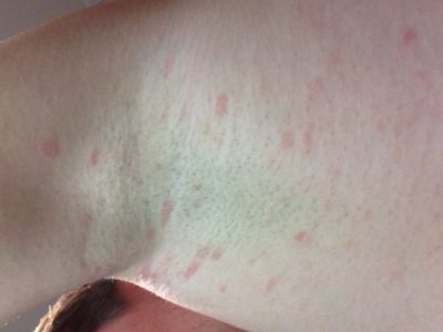 Cum de a elimina petele intunecate de sub subsuoară (axile) Cum de a elimina petele intunecate de sub subsuoară