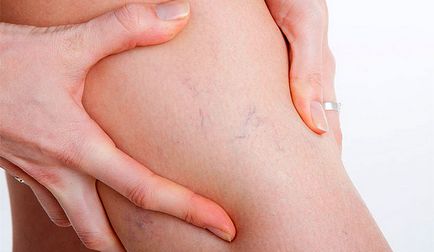 Capilarele de pe picioare - a cauzelor, de tratament și de prevenire