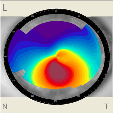 Keratoconus - cauze, simptome și tratament