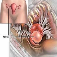 simptome chist ovarian la femei, semne de ruptură