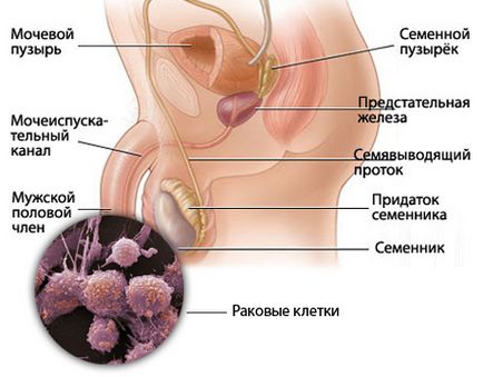 Preputului înrădăcinate la cap cauze, tratamentul adulților și copiilor - portalul urologic №1