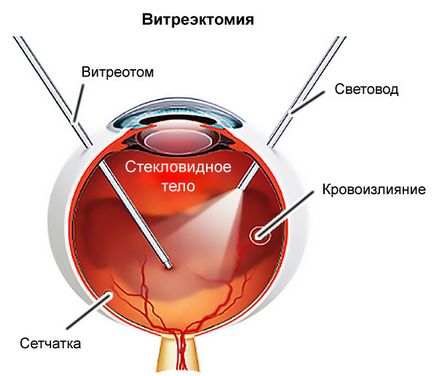 Sangerarea in cauzele ochi si tratamente care fac, prognosticul