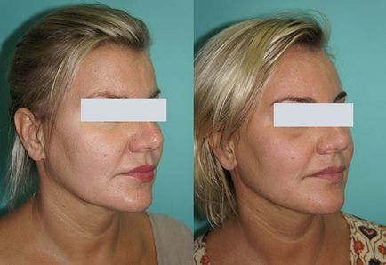 Metode de corectare a feței ovală și o bărbie dublă (corecție) Metode de corectare a conturului facial și bărbia dublă
