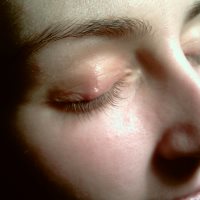 Muștele în fața ochilor cauzei și tratament adecvat