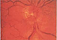 Optic nevrita - cauze, simptome, diagnostic și tratament