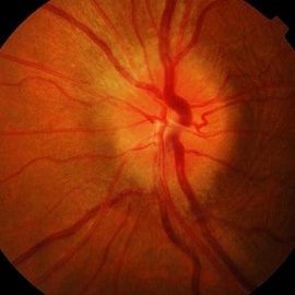 Optic nevrute simptome, tratament si tipuri de nevrita oculare
