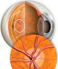 Optic nevrute simptome, tratament si tipuri de nevrita oculare