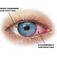 Eye Clinica - recenzie Excimer, pret, comentarii