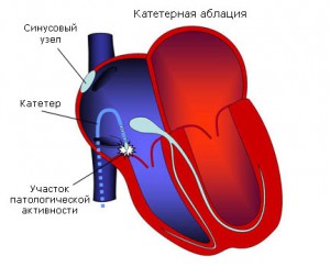 Tipuri de chirurgie cardiacă și indicații