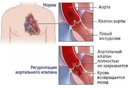 Tipuri de chirurgie cardiacă și indicații