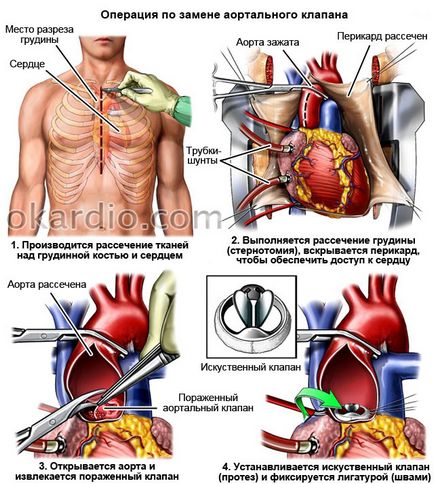 Operația de înlocuire a valvei în inima modul în care, indicații, complicații (chirurgie) Operația de înlocuire a valvei în centrul a modului în care, indicații, complicații