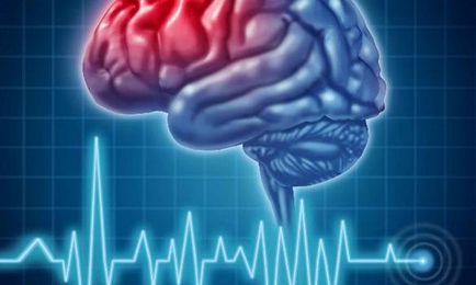 Complicațiile după accident vascular cerebral precoce și tardive (complicații) Complicațiile după accident vascular cerebral precoce și tardivă
