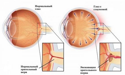 Open-unghi simptome glaucom, diagnostic și tratament