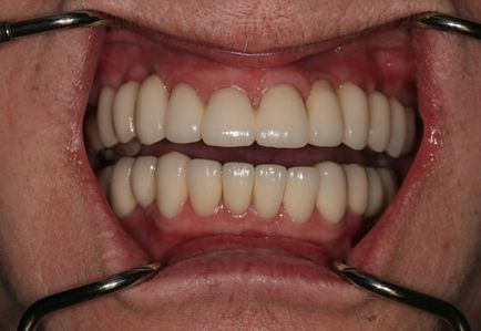 Respingerea implanturi dentare - simptome, semne, cauze